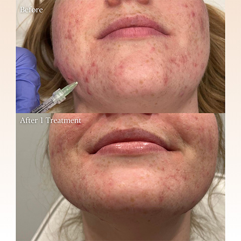 Kenalog for Acne Treatment